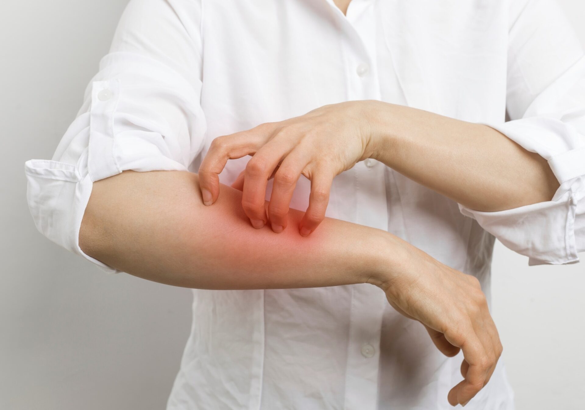 Woman Scratching Arm - Scabies Concept